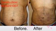 Liposuction in Mumbai | Dr Sumeet Jaiswal |Plastic surgeon |liposuction in thane/Navi Mumbai/andher