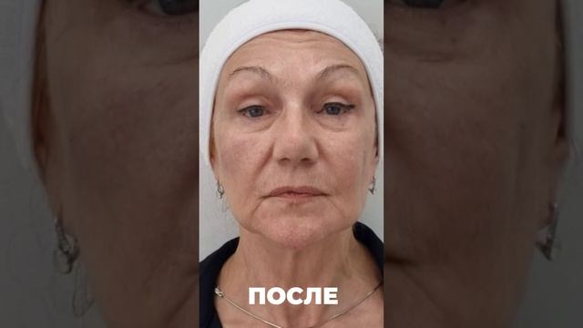 Нити не ставили. Пластики не было. Что делали - рассказали в ТГ https://t.me/Kallisto_Med #топ