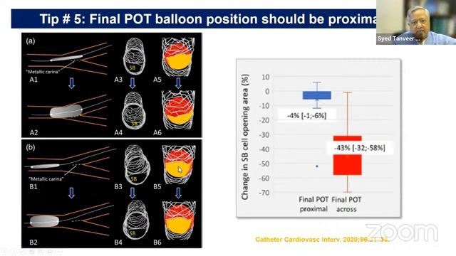 Techiniques of Left Main PCI, Prof. S. Tanveer Rab