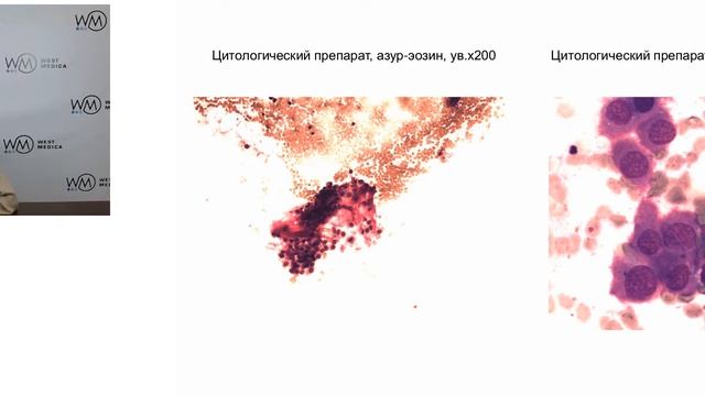 Дифференциальная диагностика опухолей слюнных желез. Часть 2 | Вебинар West Medica