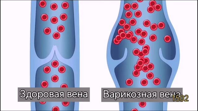 Кармановидный клапан