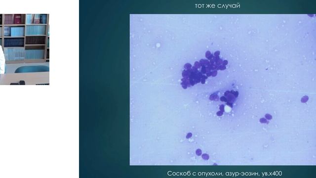 Цитологическая диагностика опухолей кожи в Иркутском онкодиспансере. Часть 2 | Вебинар West Medica