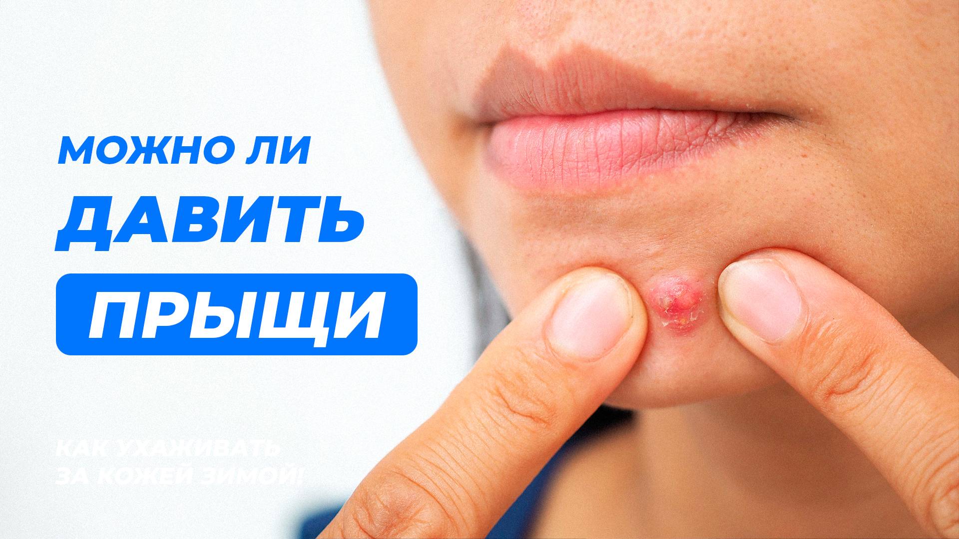Можно ли давить прыщи? Акне, Угри, Черные точки...