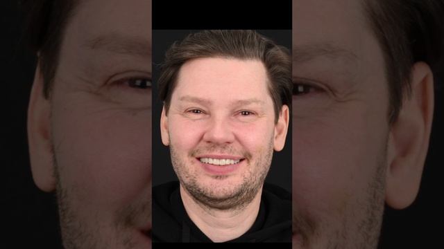Спустя 2 года после установки виниров