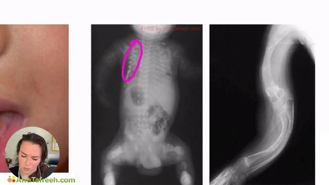 Osteogenesis Imperfecta atf