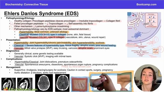 Ehlers Danlos Syndrome atf