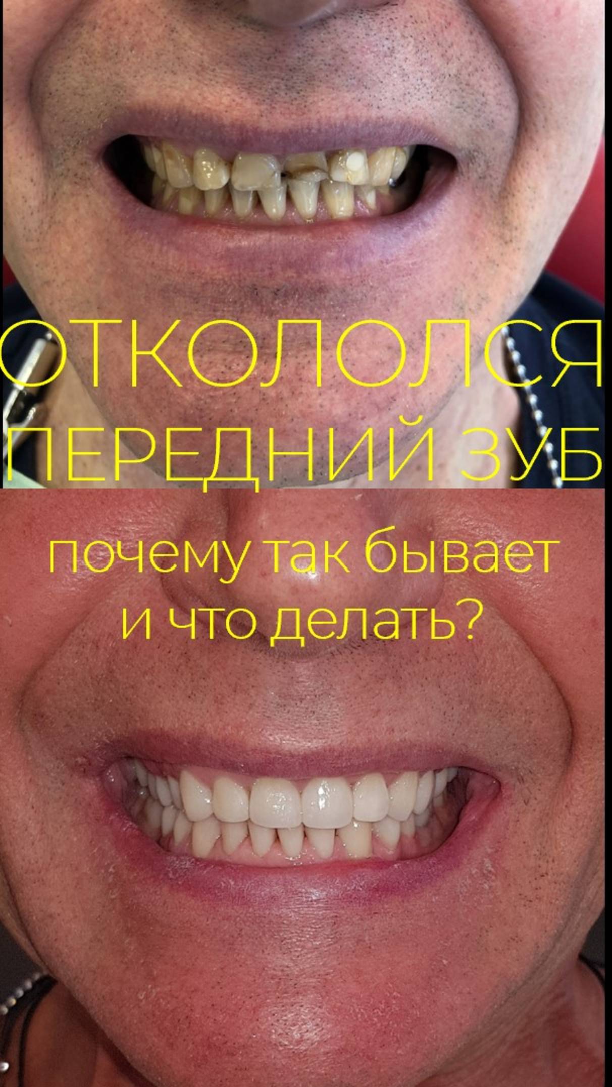 Что делать если сломался передний зуб?