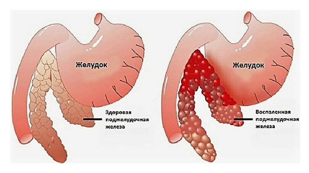 Разбираемся в нутрициологии. Поджелудочная железа. Часть 1