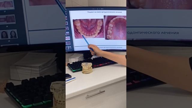 ретейнеры