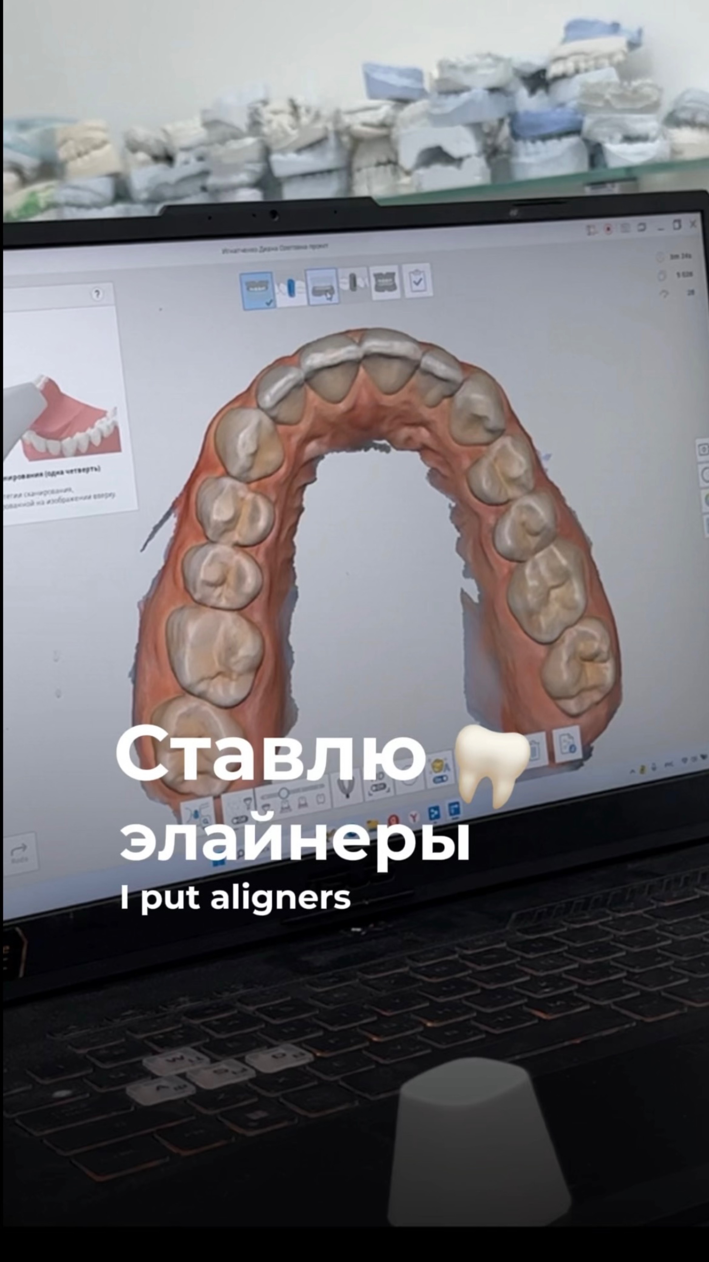 Ставлю элайнеры🦷

#рекомендации #реки #обзор #брекеты #элайнеры #стоматология #деньги #здоровье