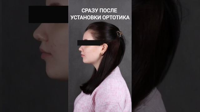 До и сразу после ортотика