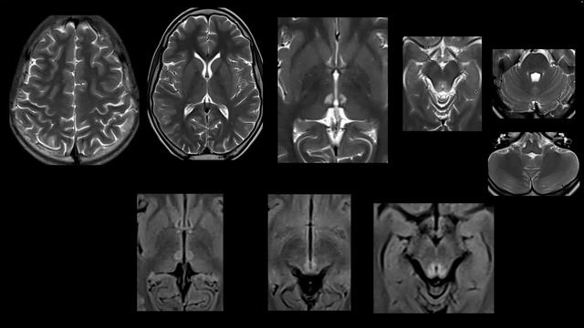 Paediatric Neuroscience Case Discussion Grand Rounds : 19th Jan, 2024