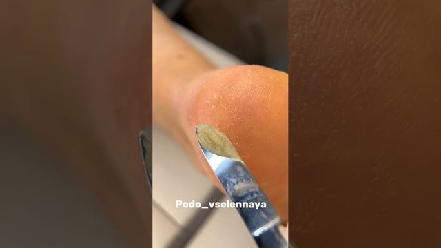 Сухие пятки зимой.
