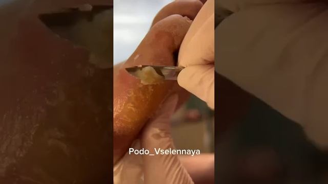 Мозоль.
