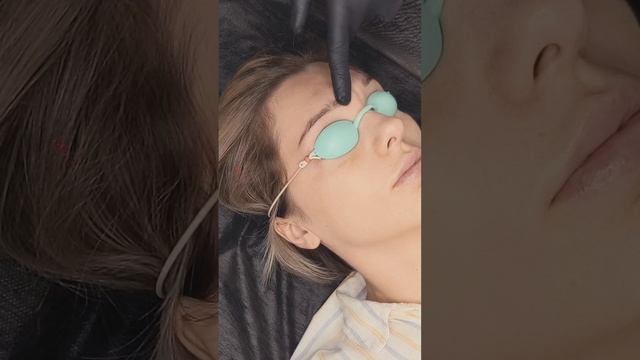 Лазерное удаление тату и перманента