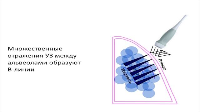Основные диагностические признаки при УЗИ легких Т.М. Бирг