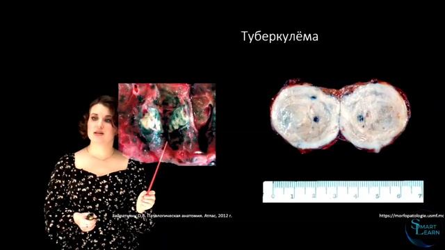 Формы-фазы вторичного туберкулёза.