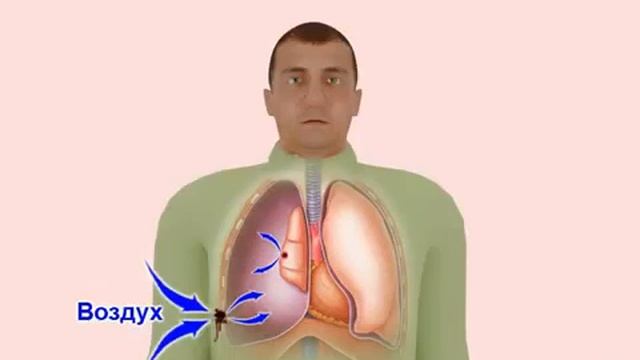 7. Травмы груди. Первая помощь