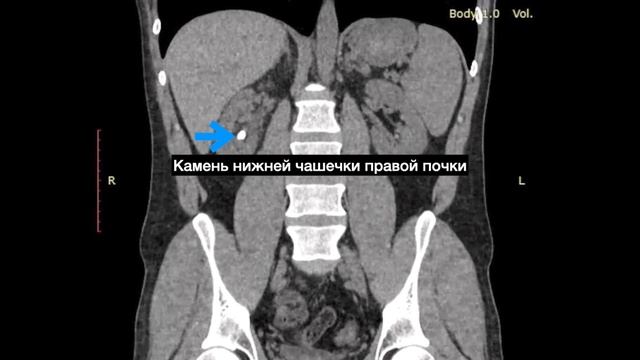 Удаление камня почки- результат операции фиброкаликолитотрипсии.