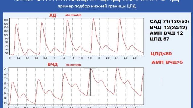 Оптимальная перфузия головного мозга 2010