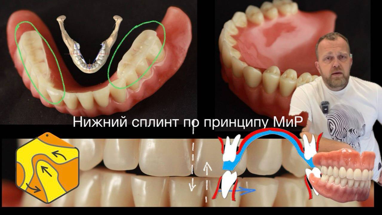 Полный съёмный протез при тяжёлом рвотном рефлексе