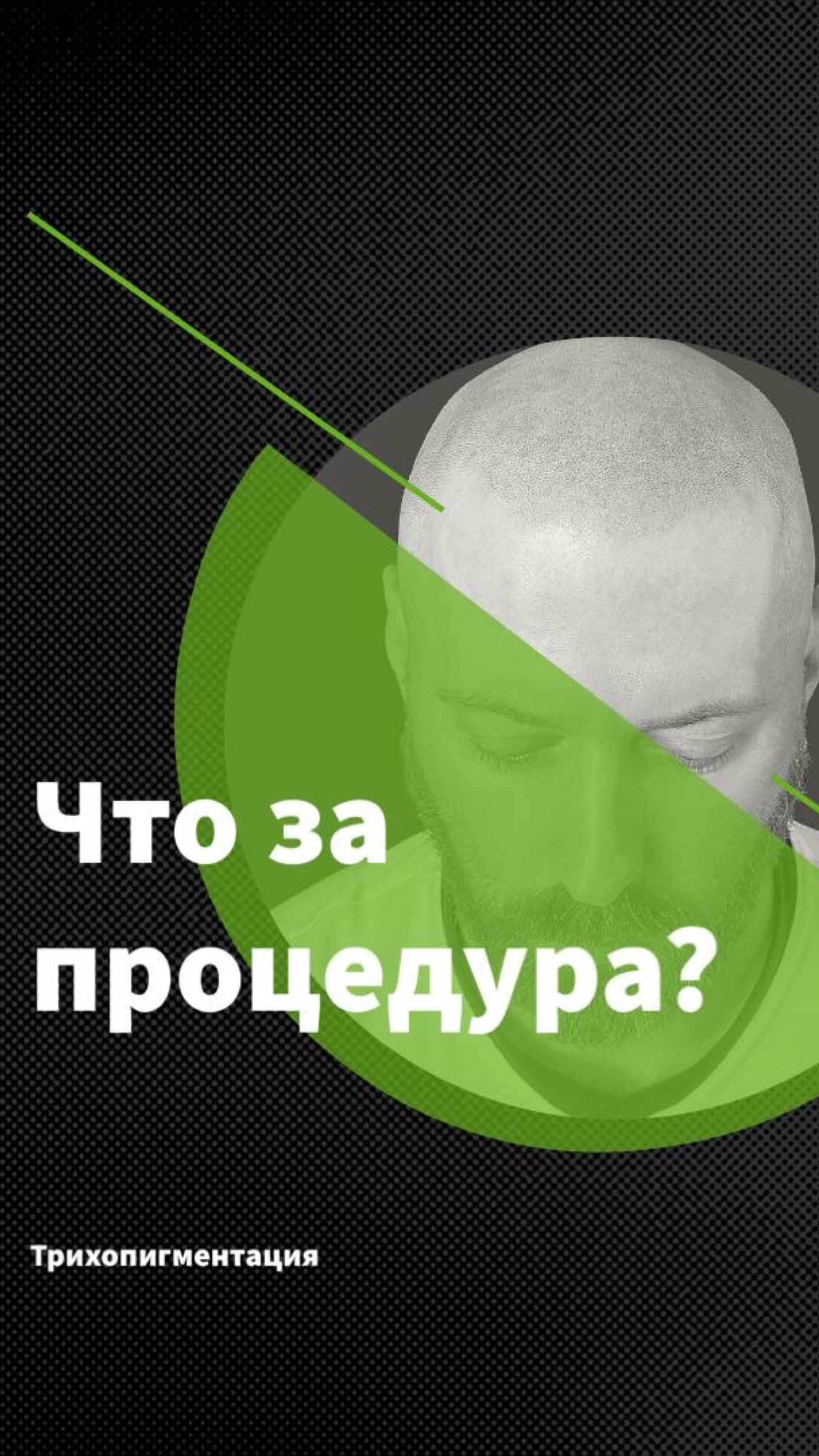 Трихопигментация для лысых и бритых
