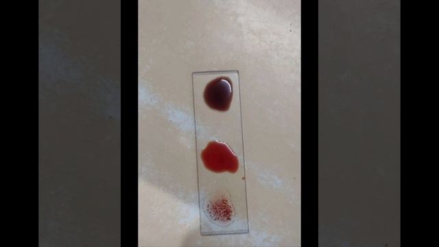 Blood group determination physiology #mbbs #homeopathy