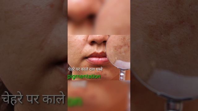 झाइयों से छुटकारा पाने का उपाय | sesderma azelac ru liposomal serum how to apply and use #short