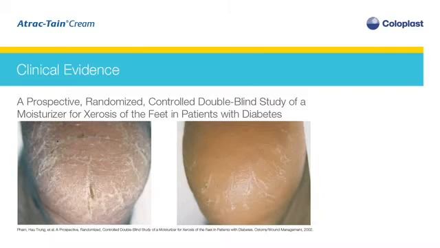 What is Coloplast Atrac Tain Cream? Why is it useful?