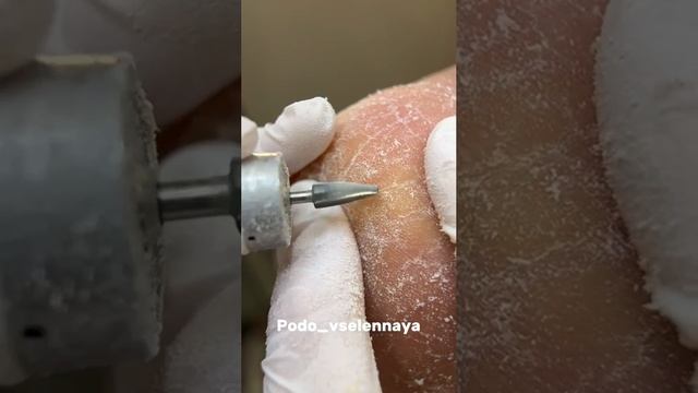 Трещины на пятках.