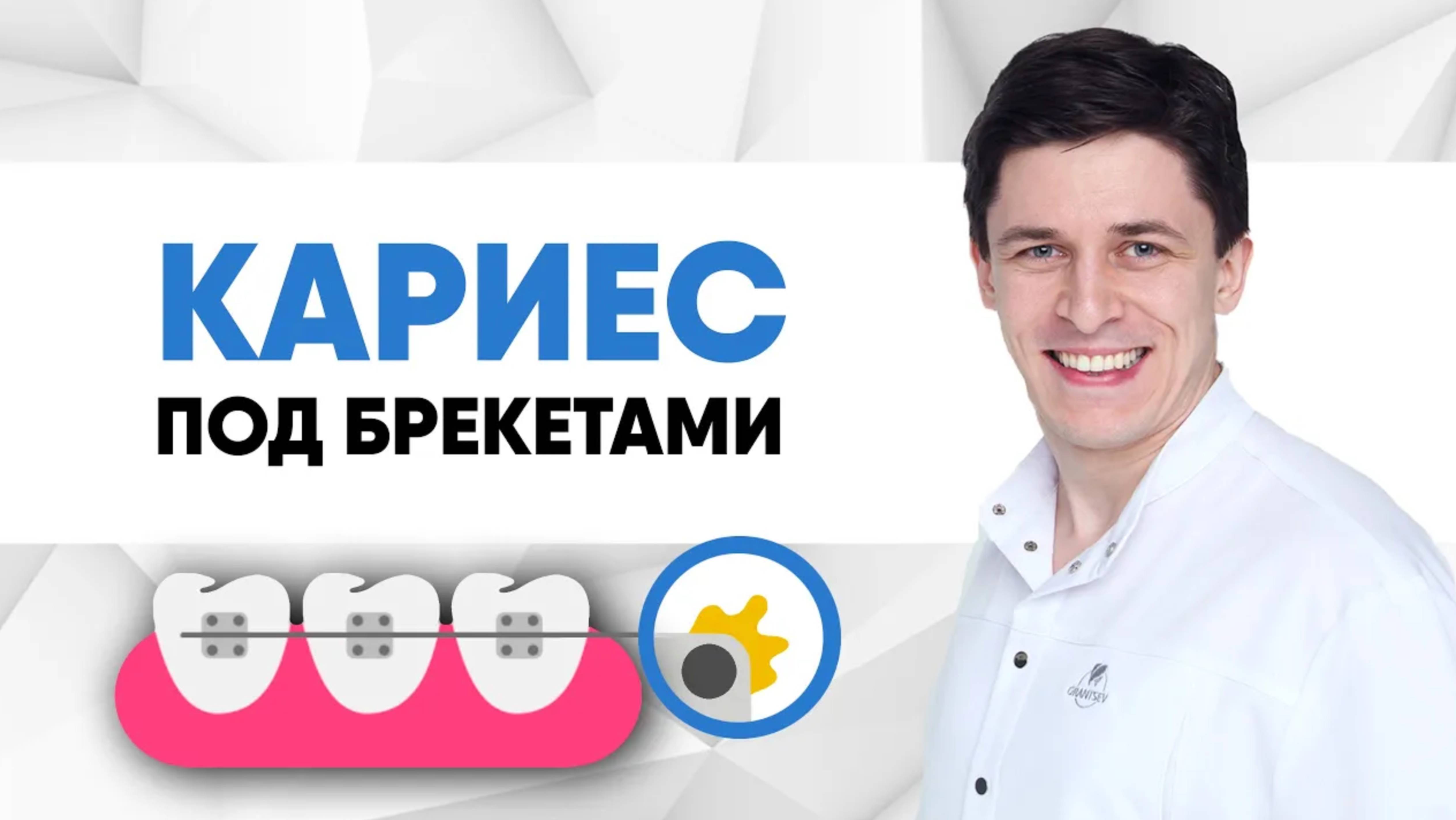 Когда возникает кариес под брекетами?