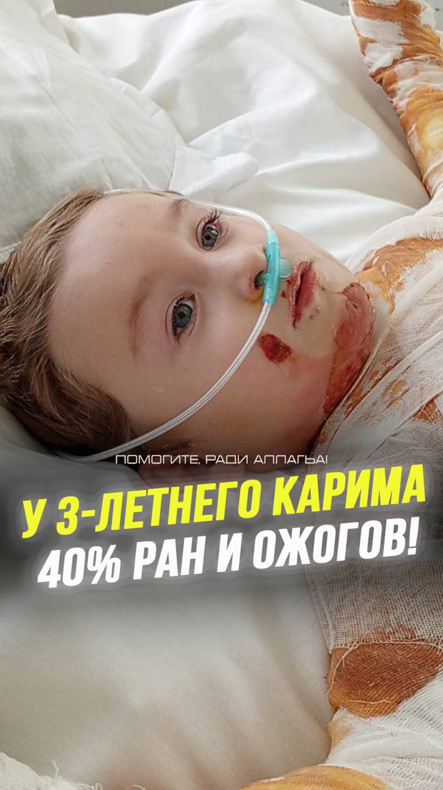 🚨 3-летний Карим с тяжёлыми ожогами в критическом состоянии!