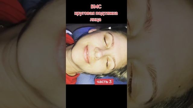 БМС подтяжка лица