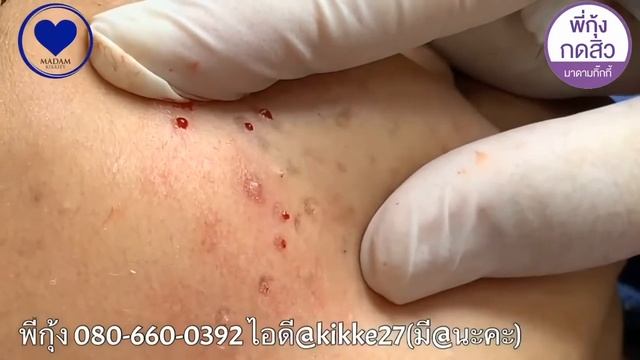 Выдавливание чёрных точек НОВОЕ! Полная чистка лица от чёрных точек  Прыщи   выдавливание и удалени