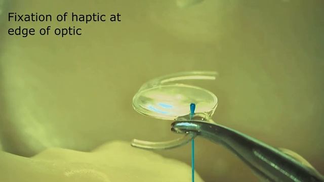 Four-flanged Intrascleral Toric lens fixation technique, by prof. Zhaboiedov Dmytro