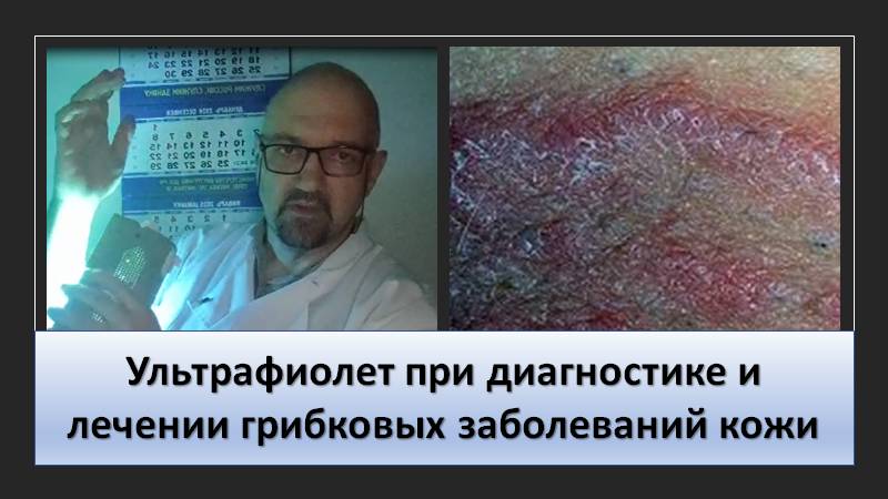 Ультрафиолет при диагностике и лечении грибковых заболеваний кожи