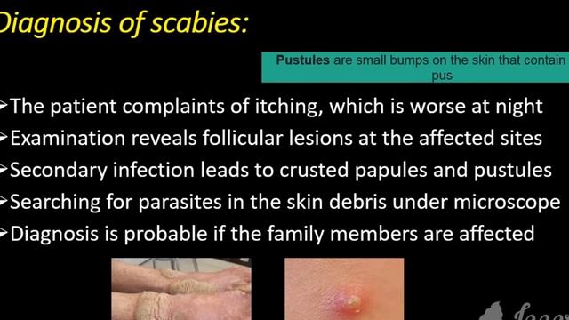 scabies