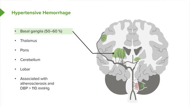 08. Hemorrhagic Stroke