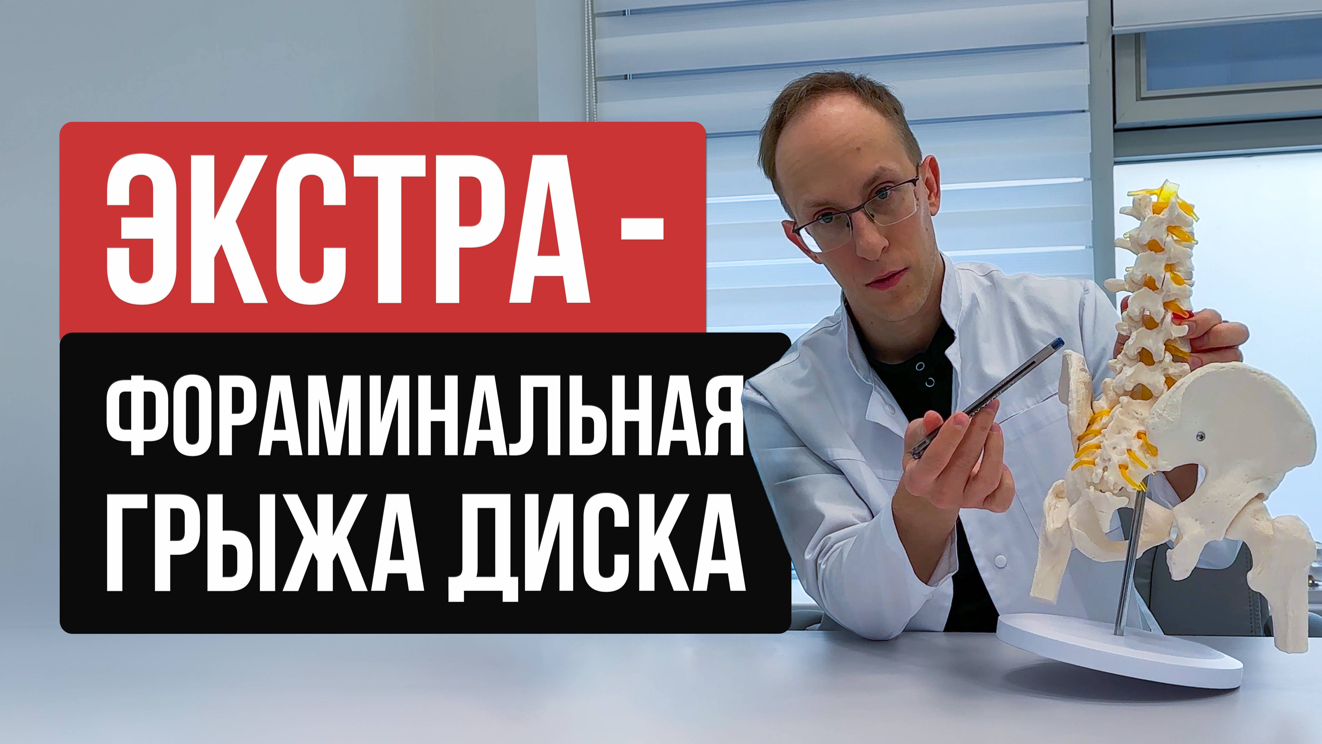 Что такое экстрафораминальная грыжа диска поясничного отдела? Как лечить? Нужно ли оперировать?