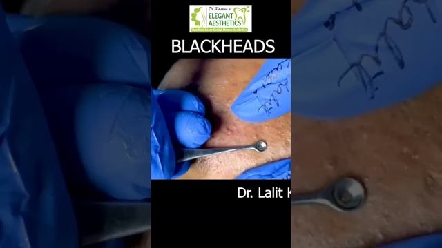 blackhead removal on face