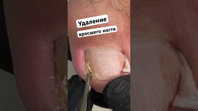 Убрать вросший кусок ногтя #ingrown_toenail #вросшиеногти #подологмосква