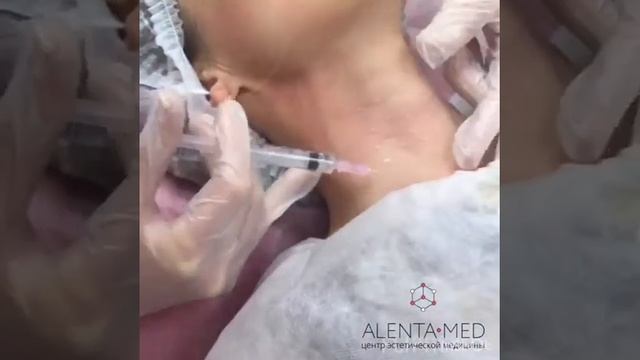 Мезотерапия для кожи Cytocare 532 в клинике Алента