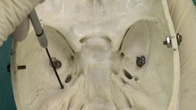 1.14 Step 21.  Foramina of the middle cranial fossa