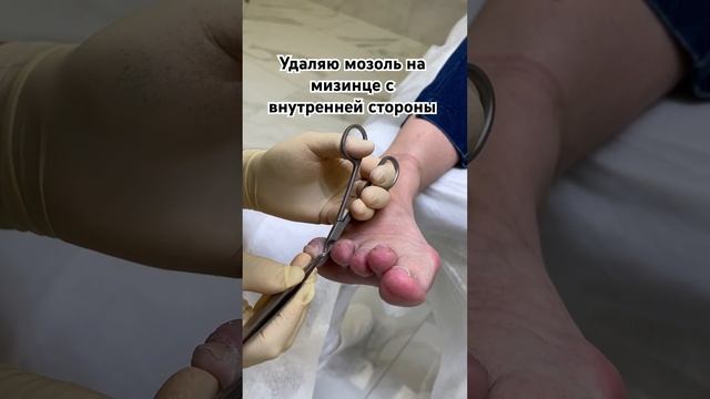 Удаление самого корня у #мозоли #подологтатьянапак #подолог