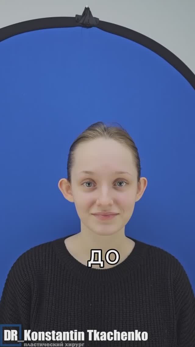 Коррекция ушных раковин.