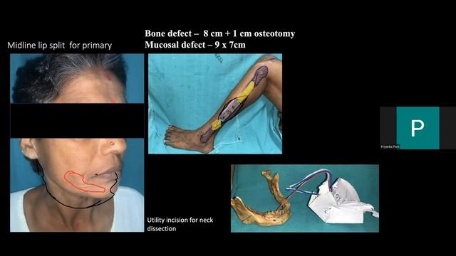 Case Discussion : Ca Buccal Mucosa