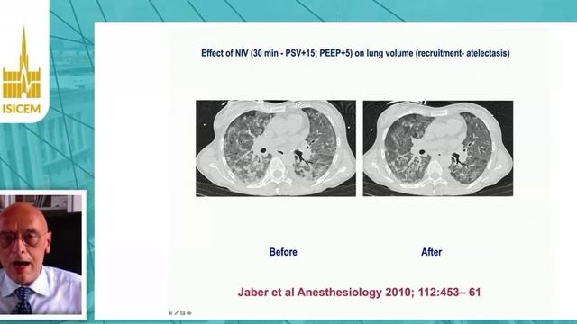 Optimal use of high flow nasal cannula Paolo  Navalesi