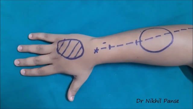 Flap posterior interposea