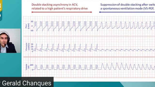 When and how to use sedative agents G  Chanques