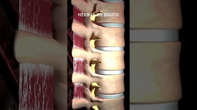 Как образуется грыжа диска